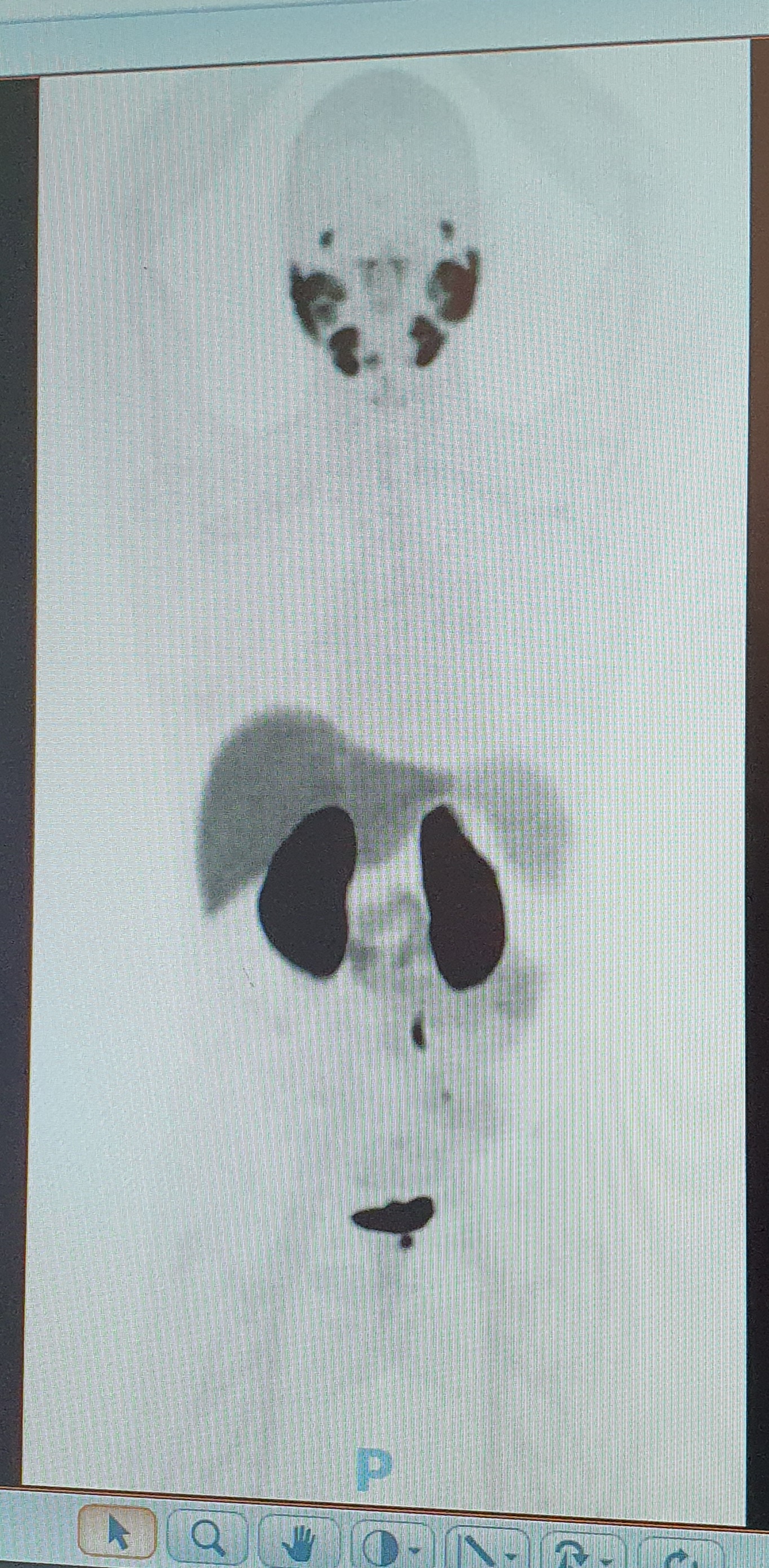 PET scan image on computer monitor showing various organs and tumour
